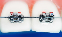 Установка брекетов в стоматологии